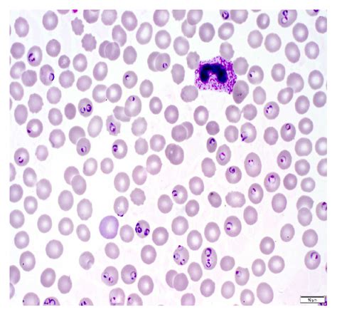 Positive Blood Smear For Malaria | Hot Sex Picture