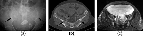 Various Musculoskeletal Manifestations Of Chronic Renal Insufficiency Clinical Radiology