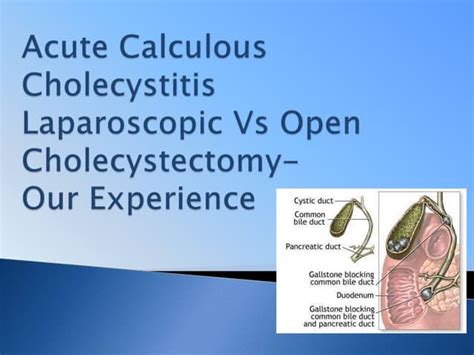 Acute Calculus Cholecystitis Open Vs Lap Pptx