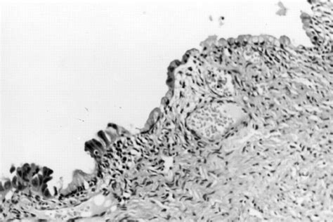 Clear Cell Carcinoma Of The Ovary Arising In A Mucinous Cystadenoma