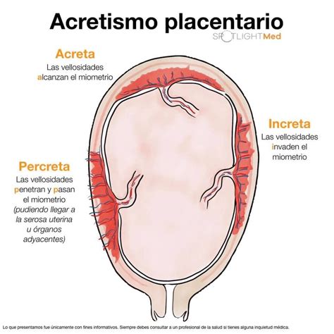 Acretismo Placentario Fuente Spotlightmed Facebook Obstetricia Y