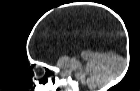 Hydranencephaly Image