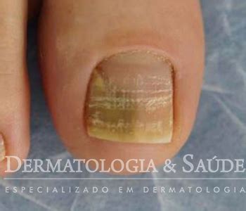 Micose Da Unha Saiba Sobre Tratamentos Dermatologia E Saude