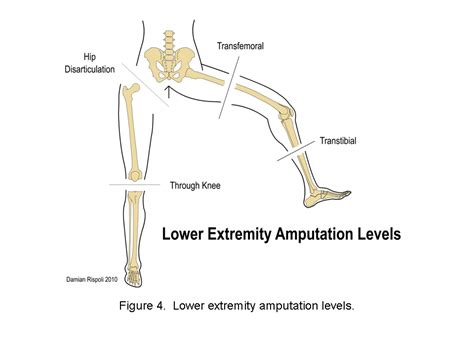 Iii Extremity Soft Tissue Care And Amputation In An Austere Environment Wheeless Textbook Of