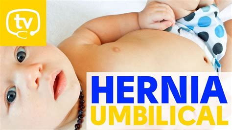 Hernia umbilical en los bebés YouTube