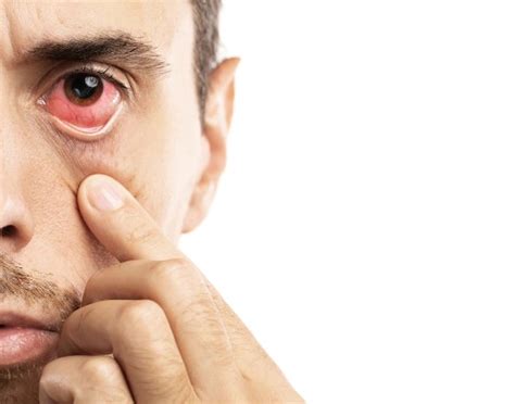 Swollen Eyes Symptoms Causes And Effective Cures Nikon