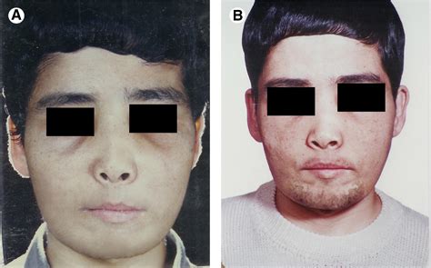 Superior Repositioning Of The Maxilla In Thalassemia Induced Facial