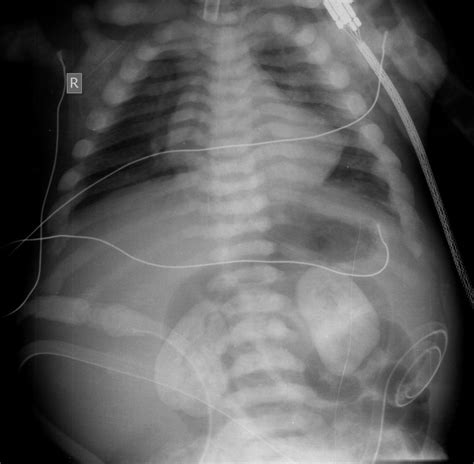 Medullary Nephrocalcinosis Radiology Reference Article