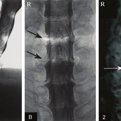 Real Time 3d Reconstruction Of Cervical Spine With Differentiation Of