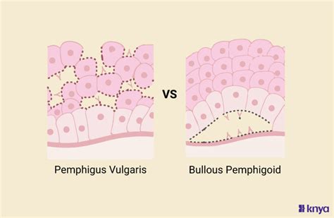 Pemphigus Vulgaris Vs Bullous Pemphigoid Explained In Detail Knya