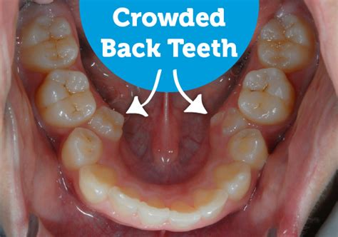 Overjet Overbite Crowded Depression Time Wasting Solution Dentistry