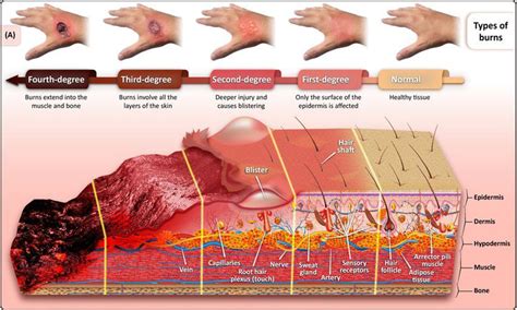 Development Of Hydrogelbased Sprayable Wound Dressings For Second And