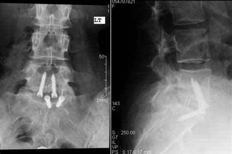 Anterior Lumbar Interbody Fusion In Nj Comprehensive Spine Care