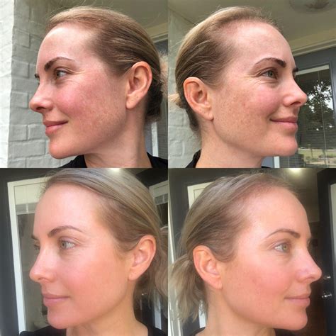 Cosmelan Peel Costs And Faqs To Treat Pigmentation And Melasma