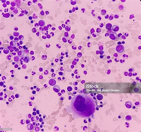 Bone Marrow Study Microscopically Show Megakaryocytes Megakaryocytic