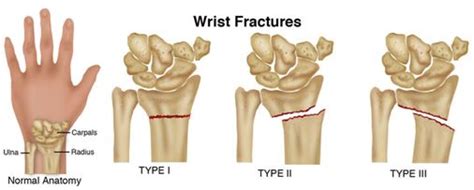 Adult And Children Wrist Fracture Specialist Singapore Orthopaedic