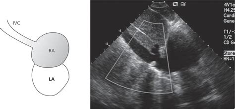 Echocardiography | Thoracic Key