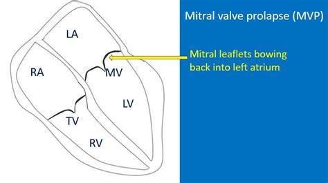 Mitral Valve Prolapse With Regurgitation Echocardiogram All About