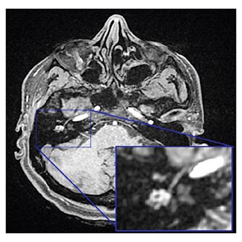 A Axial T1 Fat Saturated Magnetic Resonance Imaging Scan Of The