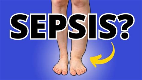 Alert Foot Ankle Swelling Edema Can Cause Serious Sepsis Know This