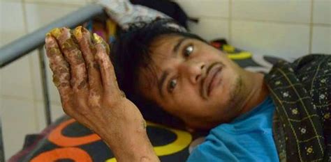 Bangladeshs ‘tree Man Once Again Admitted To Hospital For Treatment