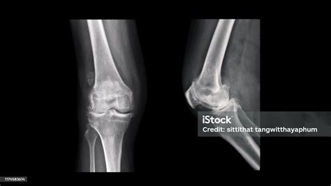 Film X Ray Knee Show Rheumatoid Arthritis Disease Knee Replacement