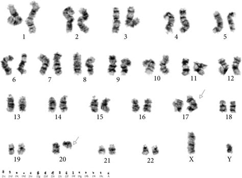 Array Cgh Conventional Cytogenetic And Fish Analyses With A