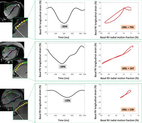 Feasibility Of A New Regional Myocardial Strain Parameter For The