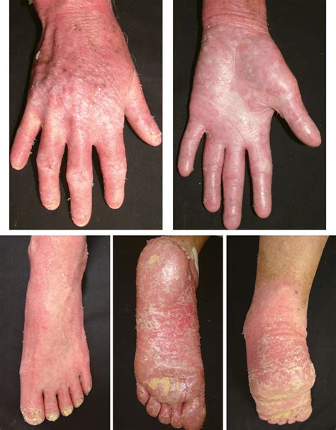 Figure 2 From Hereditary Palmoplantar Keratoderma Clinical And Genetic