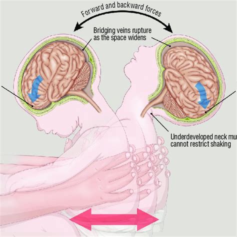 Illustration Explaining The Mechanism Of Abusive Head Trauma By