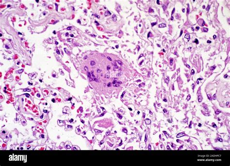 SARS daño pulmonar Micrografía de una sección de luz a través del