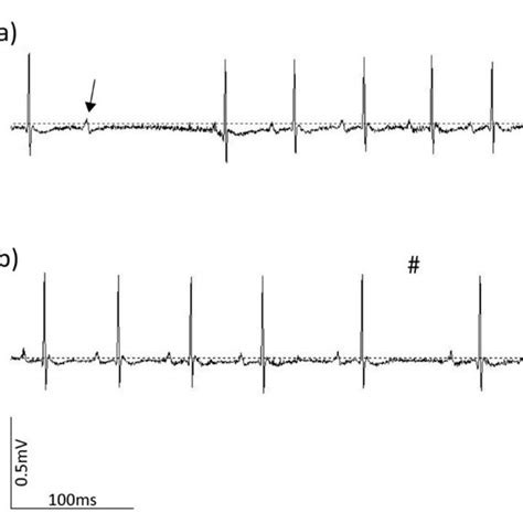 ECG shows ventricular bigeminy. | Download Scientific Diagram