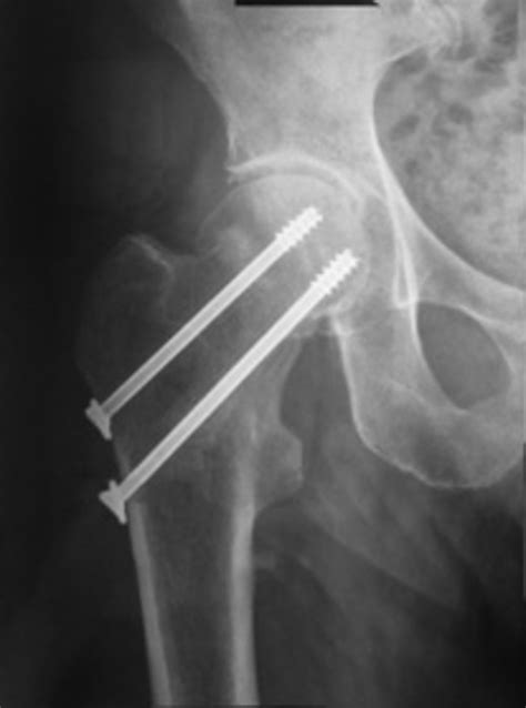 Fracture Du Col Fémoral — Ortho7