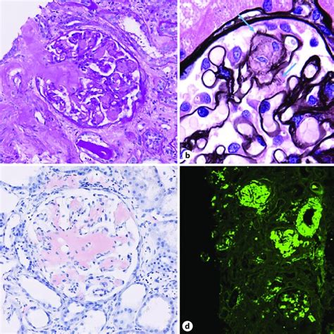 Light Chain Amyloidosis Al A Amyloid Involving The Glomeruli