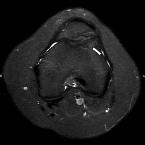 (PDF) Osteochondritis Dissecans of the Lateral Femoral Trochlea Healing ...