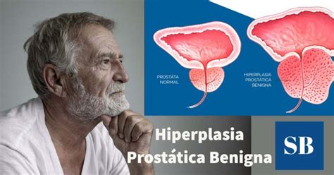 Hiperplasia Prost Tica Benigna Hpb Qu Es S Ntomas Y Tratamiento