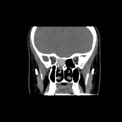 Fungal Sinusitis Pseudo Pneumatized Sinus Image