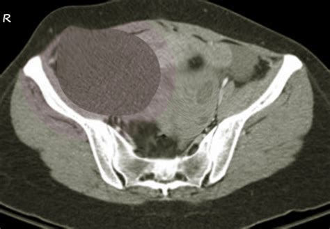 Ovarian Cystadenoma Article