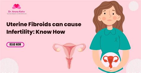 Uterine Fibroids Can Cause Infertility Know How By Dr Aruna Kalra