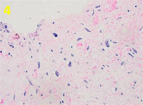 Hypocellular Infiltrate Of Pleomorphic Cells In A Loose Collagenous