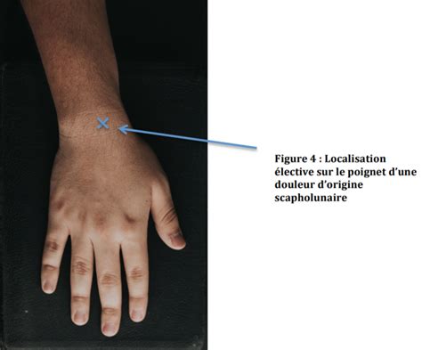 Les symptômes d une lésion du ligament du poignet Blog santé