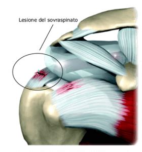 Chirurgia Artroscopica Di Spalla Ortopedico Dr Pierluigi Papi