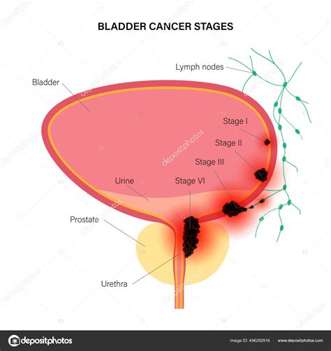 Bladder cancer stages Stock Vector Image by ©Pikovit #496292916