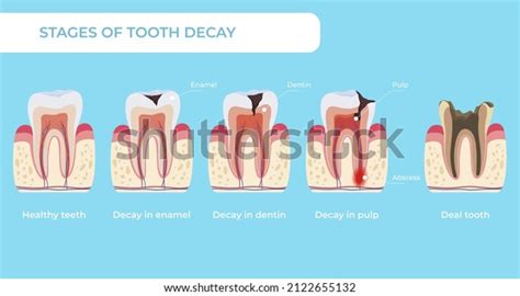 Stages Of Tooth Decay Over Royalty Free Licensable Stock Vectors