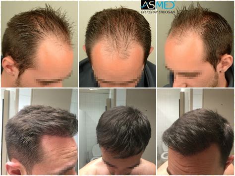 Asmed 4000 Grafts Fue Istanbul Turkey Hair Transplant In Turkey