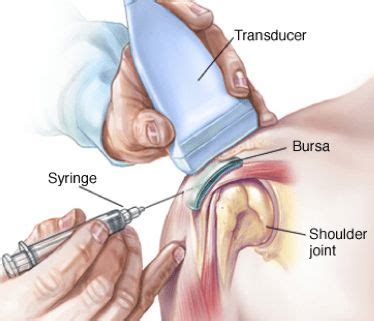 Slijmbeursontsteking Schouder Snel Verhelpen Fysiotherapie4all Nl