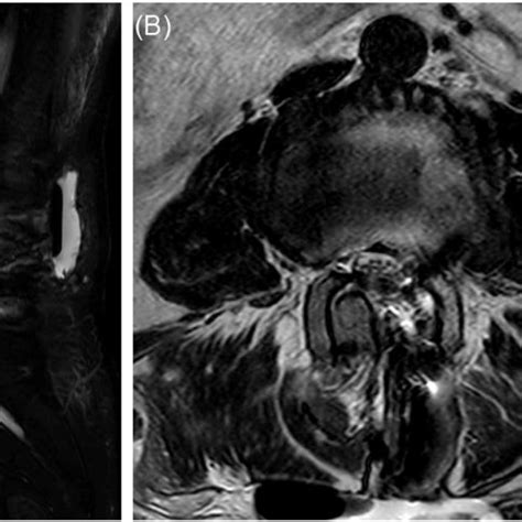 A Compression Bifrontal Supra And Infratentorial Pneumocephalus