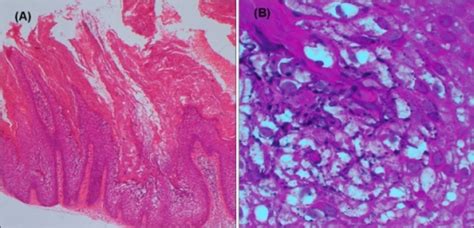 Figure 2 Isolated Epidermolytic Acanthoma In A Renal Transplant