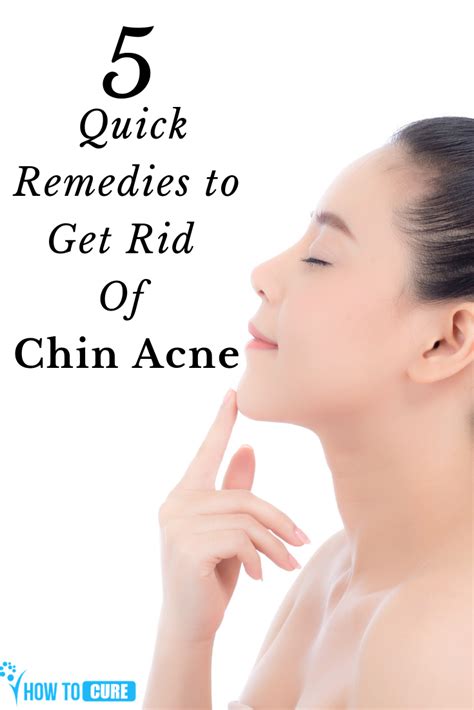 5 Quick Remedies To Get Rid Of Chin Acne Howtocure Chin Acne Causes Chin Acne Acne Causes