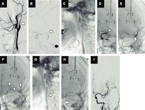 Cerebral Angiography And Endovascular Recanalization A The Cervical